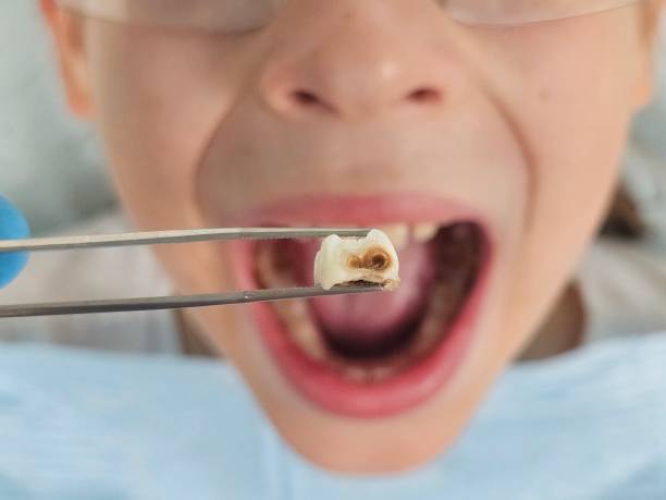 Best Emergency Dental Care for Broken or Chipped Teeth in Cramerton, NC